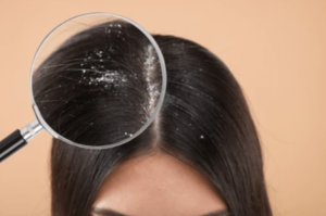 The Hidden Reasons for Dandruff and How to Handle It